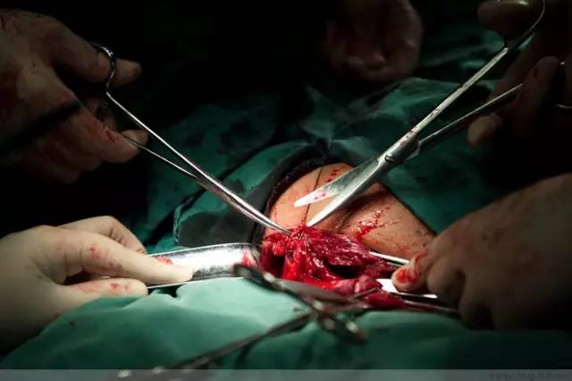 100张剖腹产高清照片看完才知道生孩子有多不容易