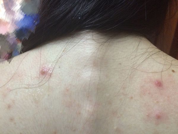 后背长痘不断,暗示螨虫"过万",不除螨别想痘痘能消