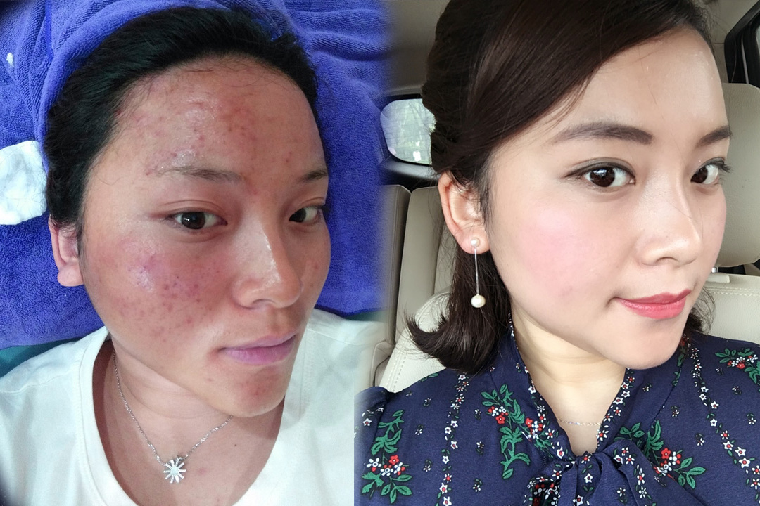 闭口粉刺怎么去除女大学生教你一招祛除闭口粉刺的有效方法