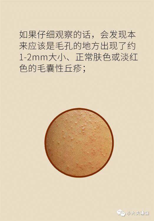毛周角化症恼人的鸡皮肤我该怎么拯救你
