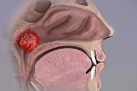 不整齐并且凸出来,上嘴唇也会变厚,鹗骨弓起变高,这样的孩子的面部,很
