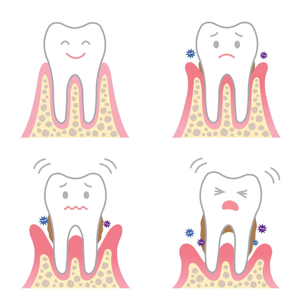 如果得了牙周病是"真心话",那不治疗就是"大冒险"!