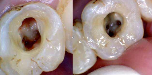 牙体牙髓病还有救吗?