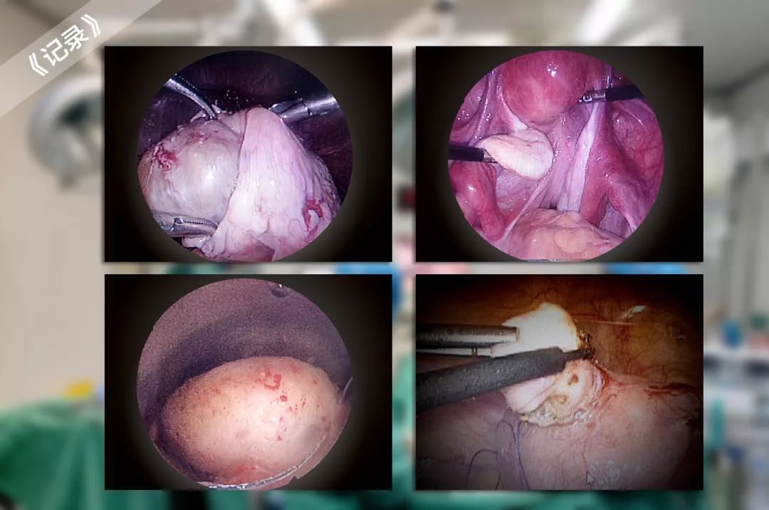 妇科专家帮你捋一捋子宫肌瘤腺肌症内膜异位症的亲属关系