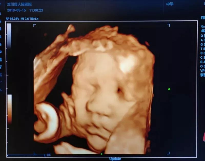 五个月四维彩超胎儿图片