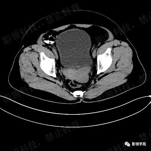 闊韌帶平滑肌瘤與子宮漿膜下肌瘤的鑑別