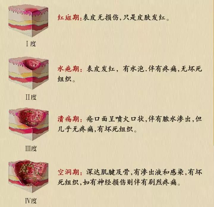 褥疮的定义与分期伤迪简化整理一文了解褥疮