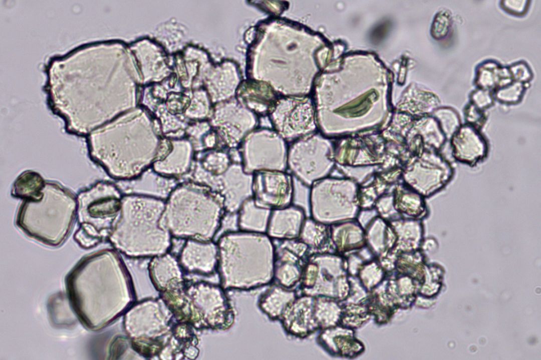让人痛不欲生的尿酸结晶居然这么美