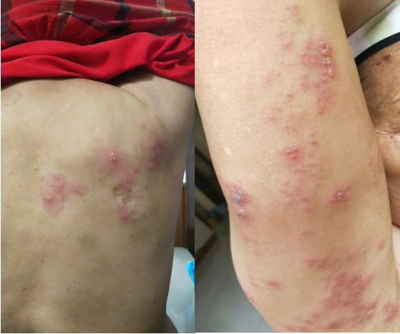 带状疱疹 -李道政虎符铜砭辨证配穴案例解析