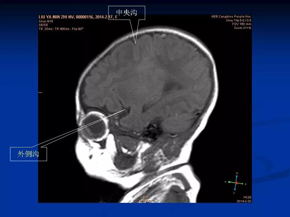新生兒顱腦mri解剖及常見疾病67一影像天地