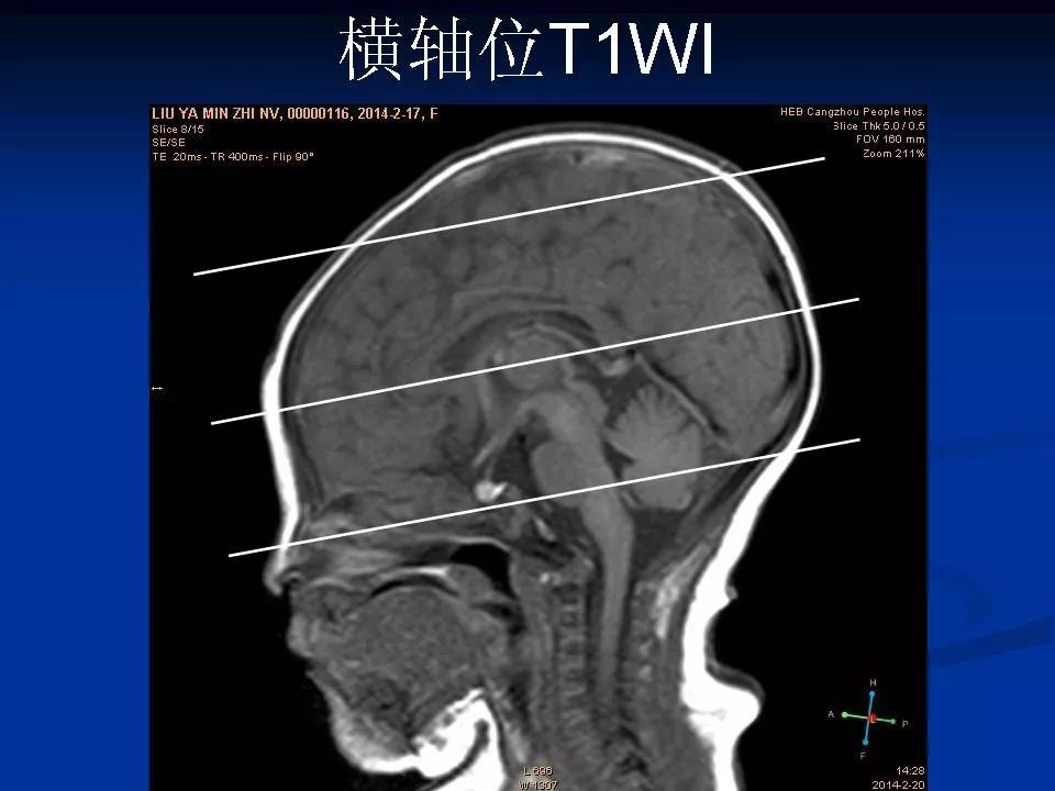 新生儿颅脑mri解剖及常见疾病67(一)