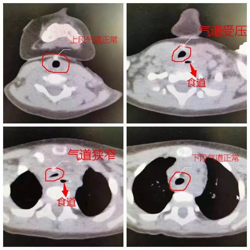 惊!8月龄宝宝食道内藏硬质贴画,真相是