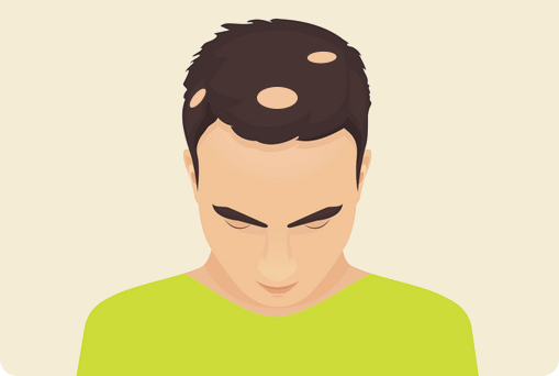 每日新get√_斑秃