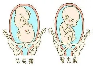 双胞胎顺产胎位图图片