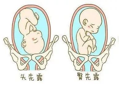 【暖心】产妇双胞胎之一胎位异常,却要求顺产,医生这样做,点赞!