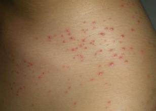 症状为剧烈瘙痒,搔抓后常引起抓痕,血痂,或继发脓疱疮及毛囊炎等细菌