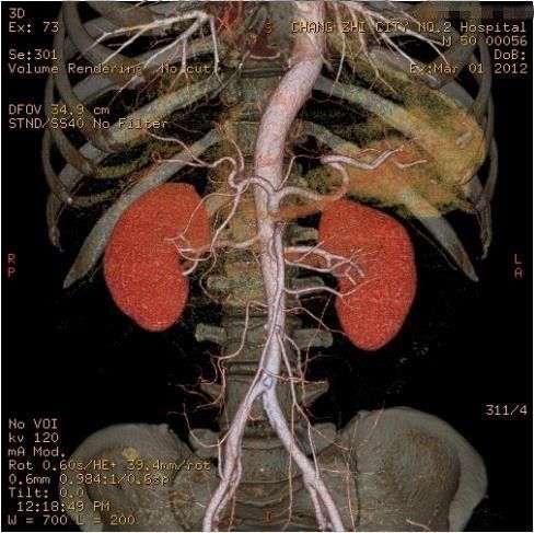 肾动脉CTA图片