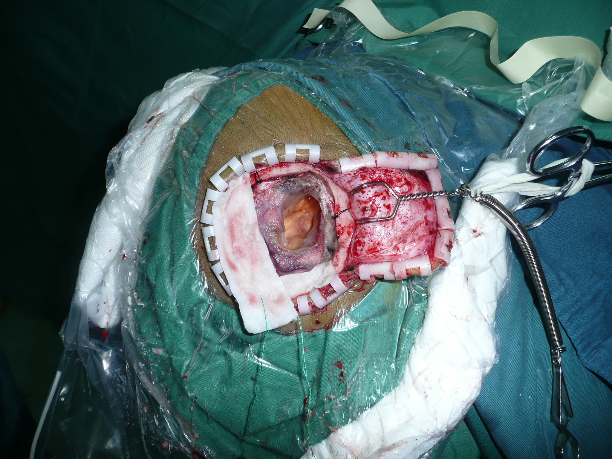 蛛网膜囊肿手术图片