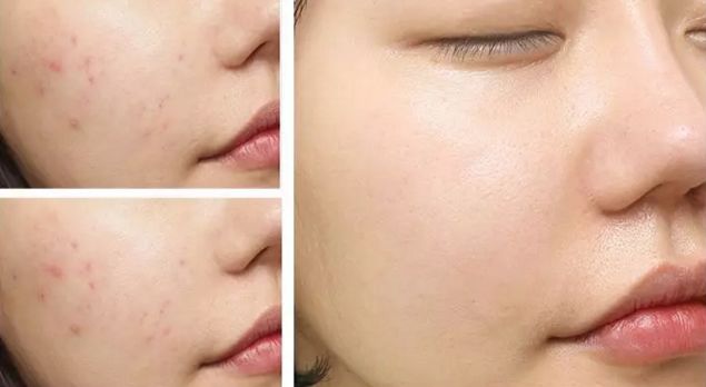 痘痘问题大多是因为饮食习惯差,压力大,熬夜多导致皮脂分泌旺盛,积攒