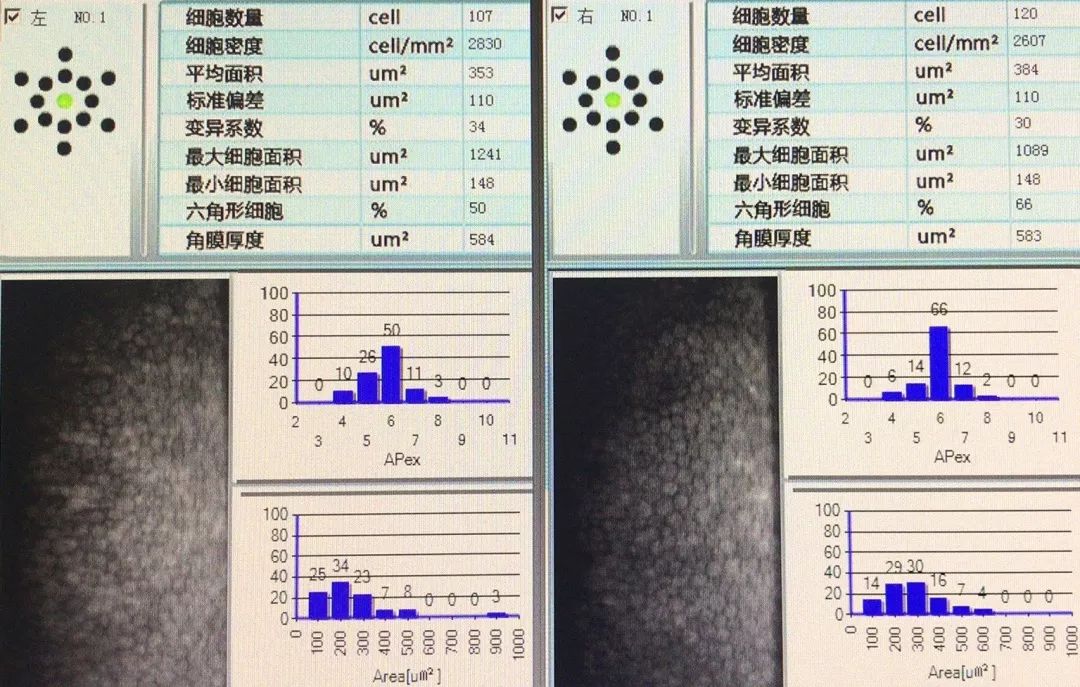 ubm:虹膜表面欠光滑并见多个高反射点图3 眼底照相示:杯盘比约为0.