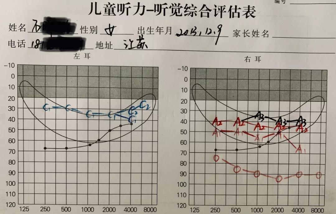 基本听力情况1听力检查:左边已经植入人工耳蜗,右边未助听平均听力为