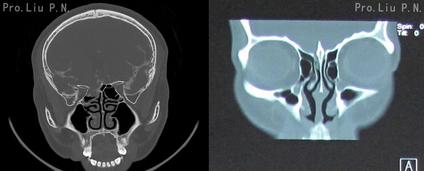 自发性鼻漏漏口多位于蝶窦侧壁,筛板2. 找存在炎性改变的窦腔1.