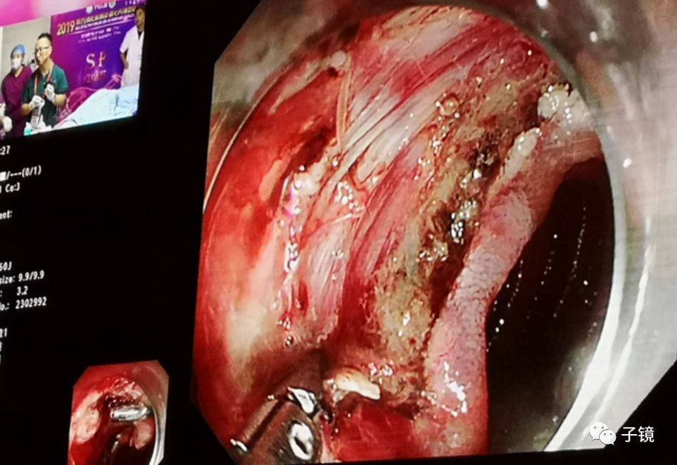 ct:空腸及迴腸可見多發性節段性腸壁增厚並異常強化,符合克羅恩病.