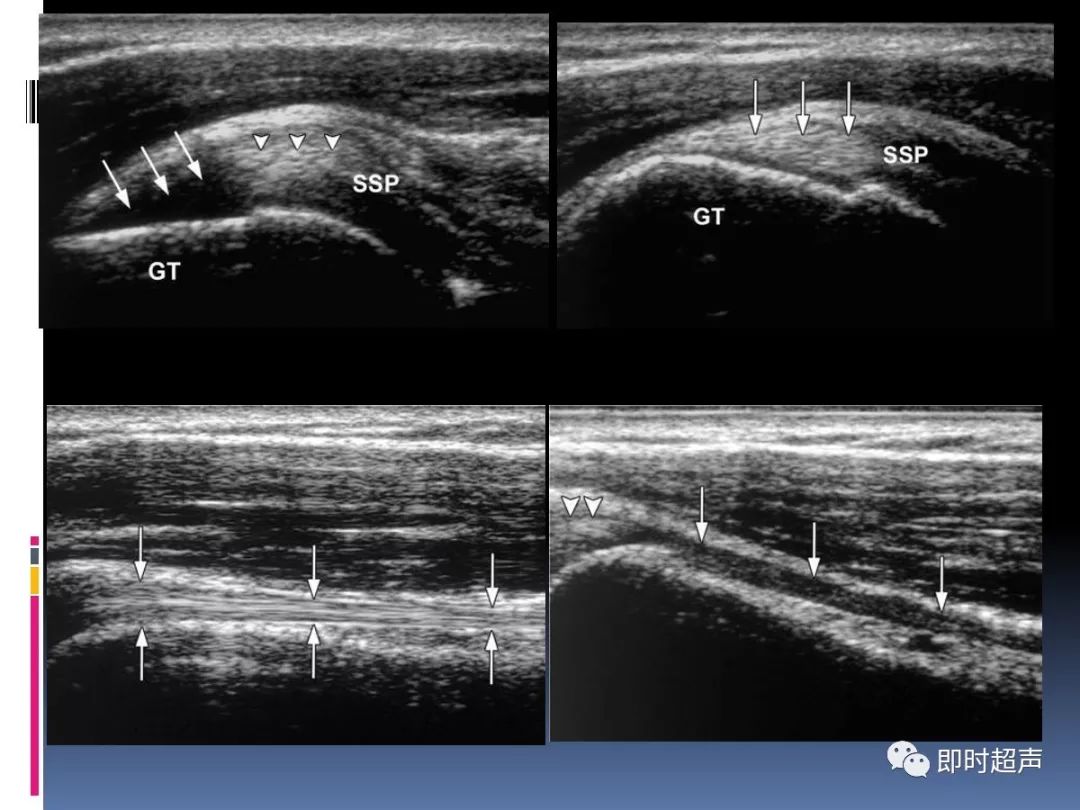 肩关节超声影像诊断