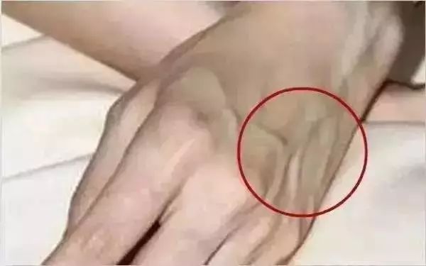 肚皮上此部位青筋暴突可能你的肝已经硬化