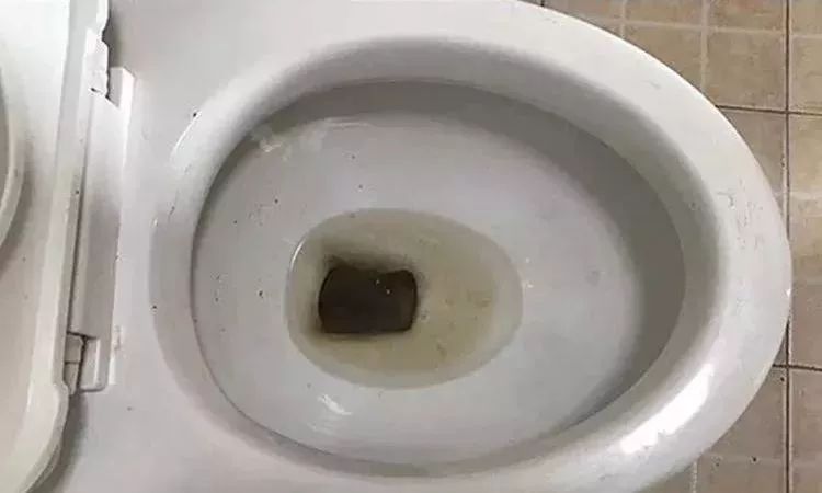 的时候冲到厕所,裤子都脱一半了,一低头:马桶壁上厚厚一层陈年尿垢