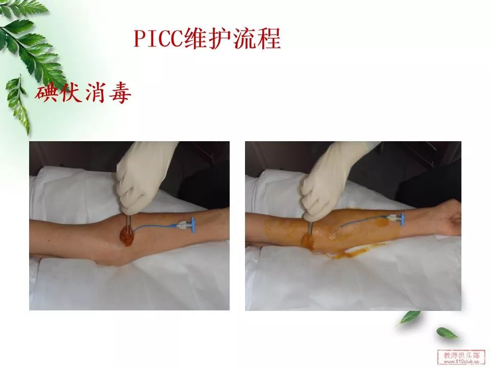 pptpicc导管的维护这篇真的很详细