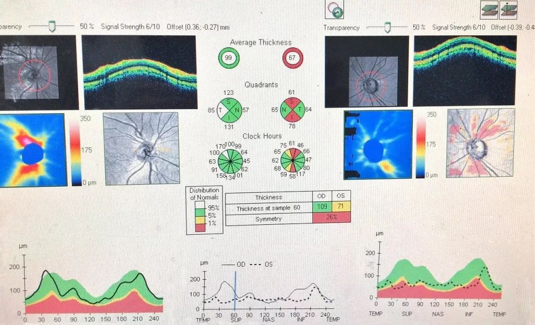 多发性虹膜痣综合征1例ame病例讨论
