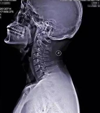 这样看颈椎x线你也能成为高手