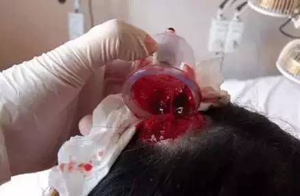 泻血疗法治百病