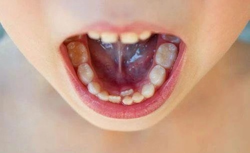 孩子的乳牙更容易患蛀牙,这跟乳牙的解剖结构,组织形态,矿化程度和