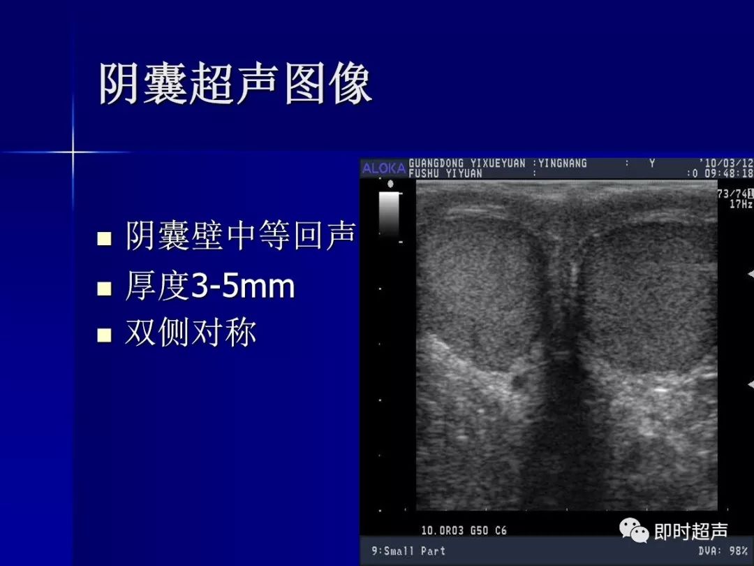 正常睾丸彩超图图片