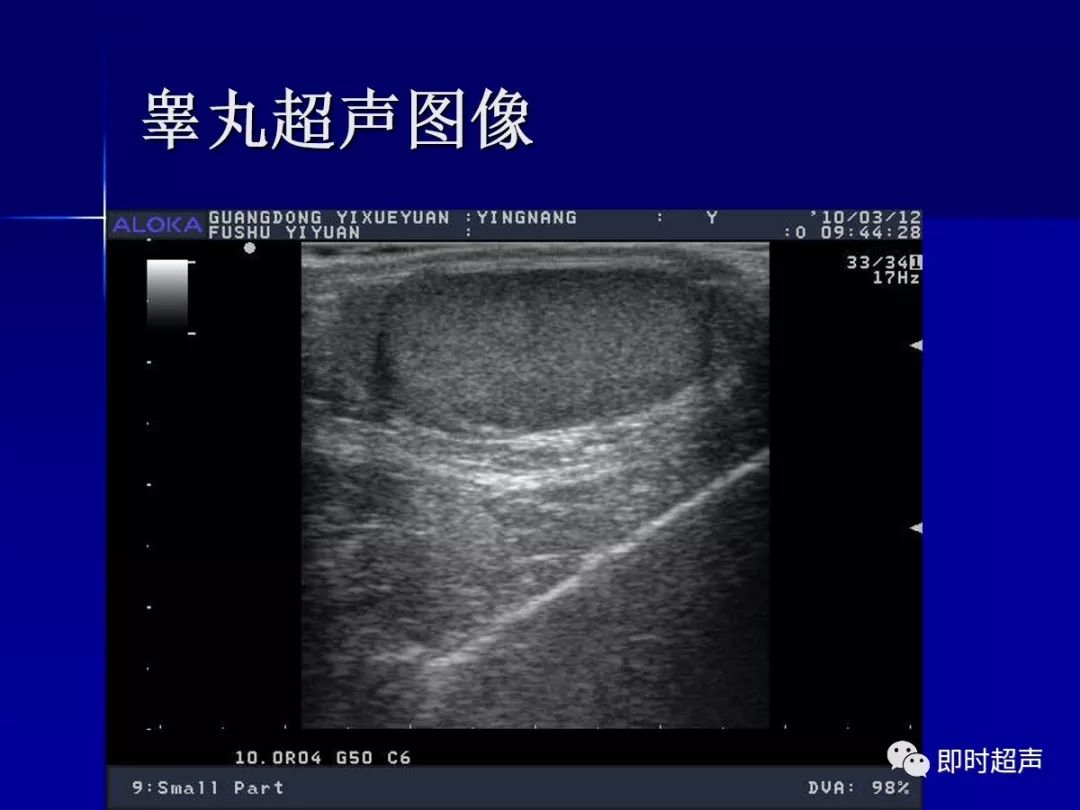 阴囊及其内容物的超声诊断