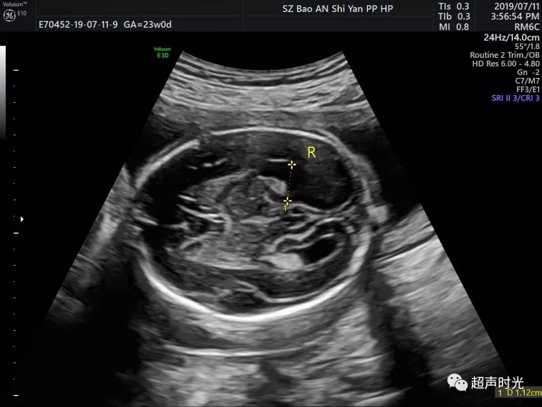 胎儿侧脑室解剖图图片