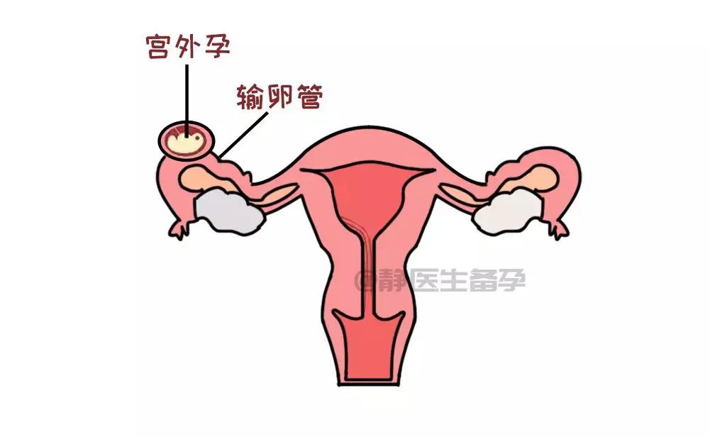 静医生备孕:宫外孕伤害那么大,想预防男人们也不能闲着