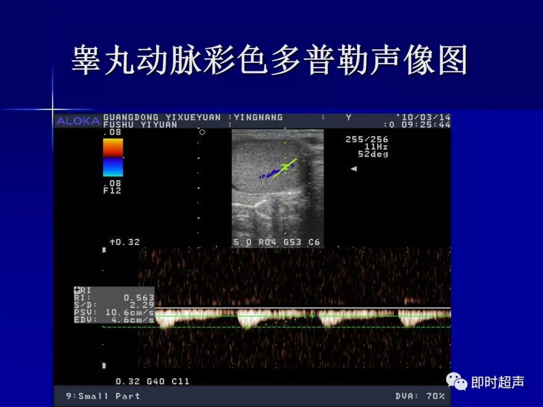 陰囊及其內容物的超聲診斷_睪丸