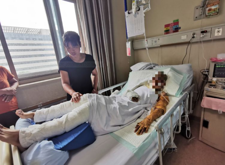 四肢被裹上了纱布面部,前胸和四肢都被烧伤从重症病房转出来25岁的
