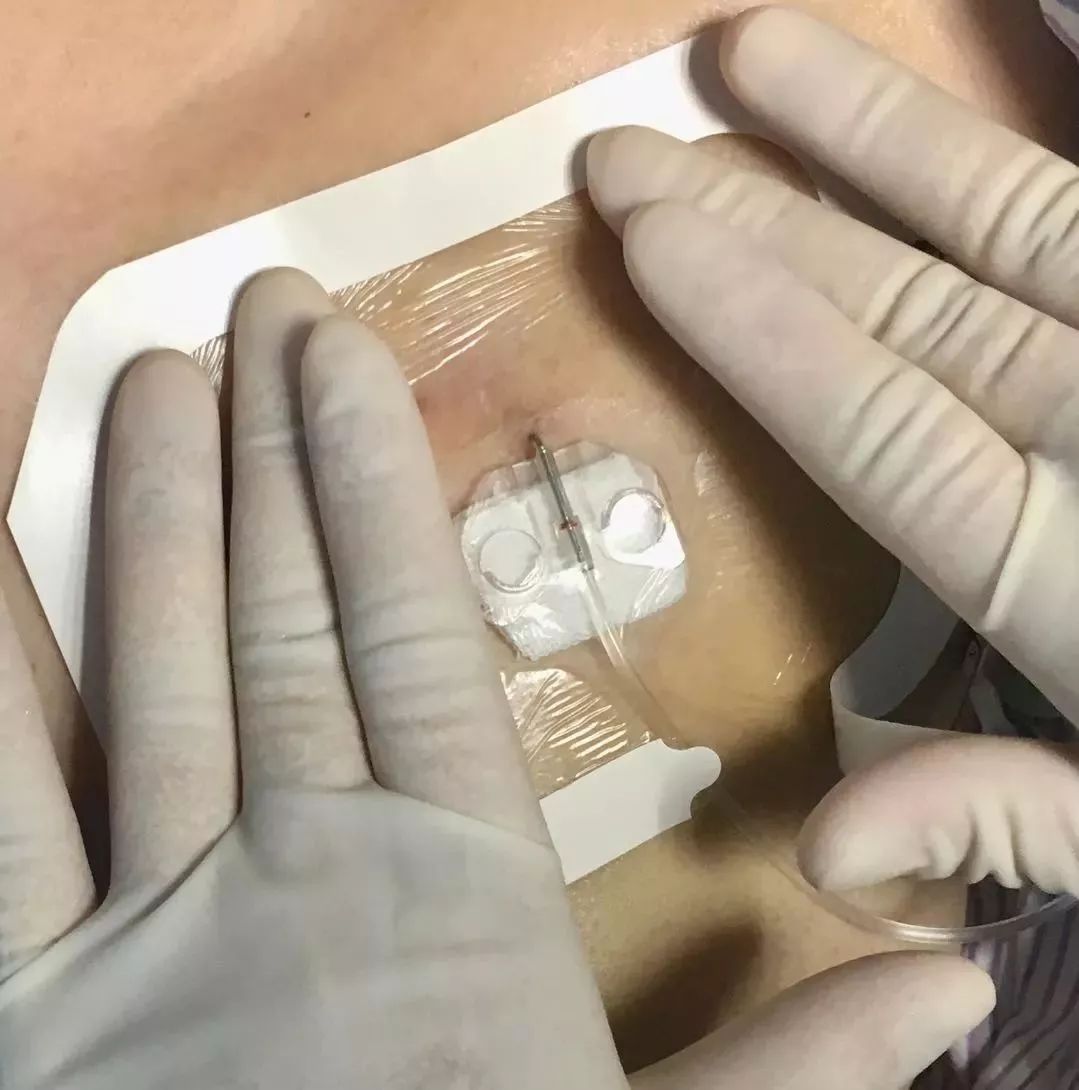 输液港蝶翼针:横着扎还是竖着扎?