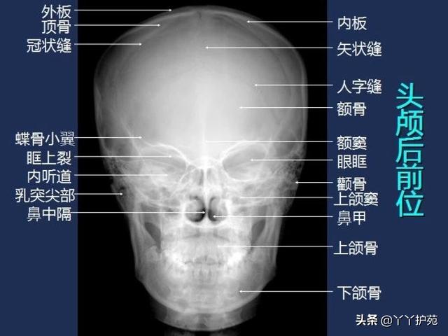 头颅正位片解剖图片