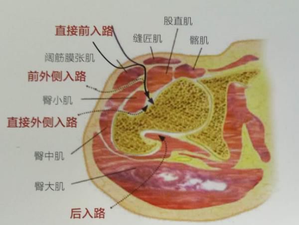 daa入路髋关节置换,早期康复,无需束缚,健步人生!