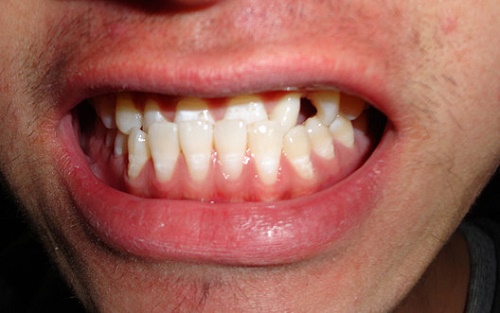 为什么会地包天包住的是牙齿也是你的未来