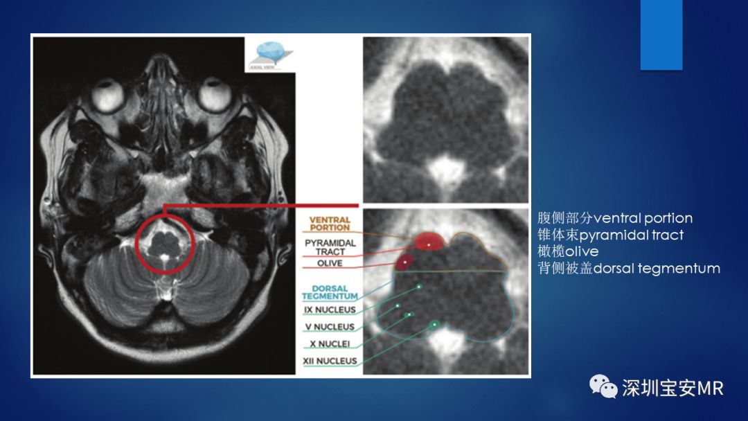 中脑脑桥及延髓解剖和综合征