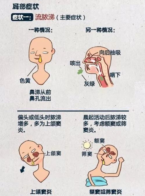 鼻塞的原因图解图片
