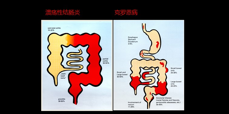 腸·道|吳開春:23分鐘講透綠色癌症—炎症性腸病_克羅恩