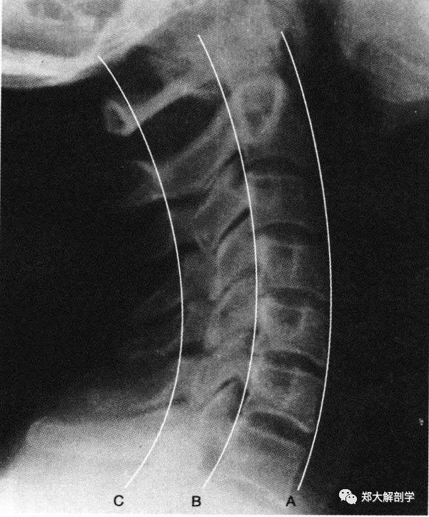 正常颈椎侧面图图片