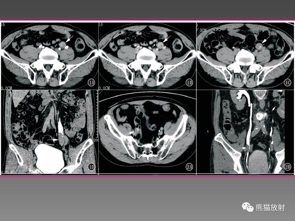 输尿管肿瘤影像诊断及鉴别诊断